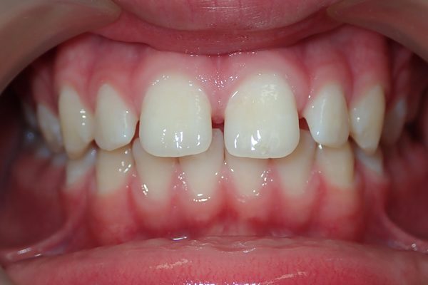 Fin before orthodontic treatment at Greenwich