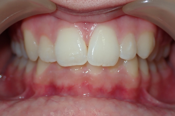 Sumeya before orthodontic treatment at Greenwich