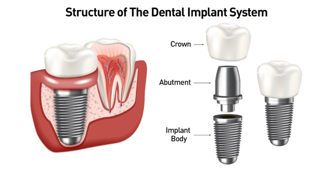 dental implants in greenwich south east london