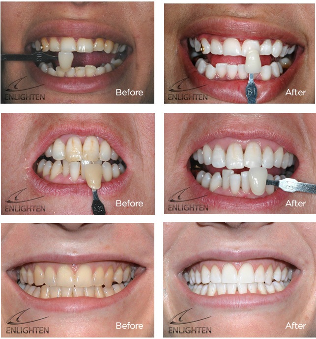 Enlighten teeth whitening Greenwich South East London