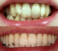 Invisalign before and after Greenwich