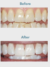 Polanight teeth whitening in Greenwich