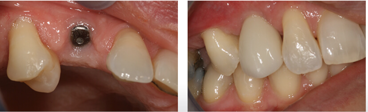 single tooth implant before and after example in Greenwich